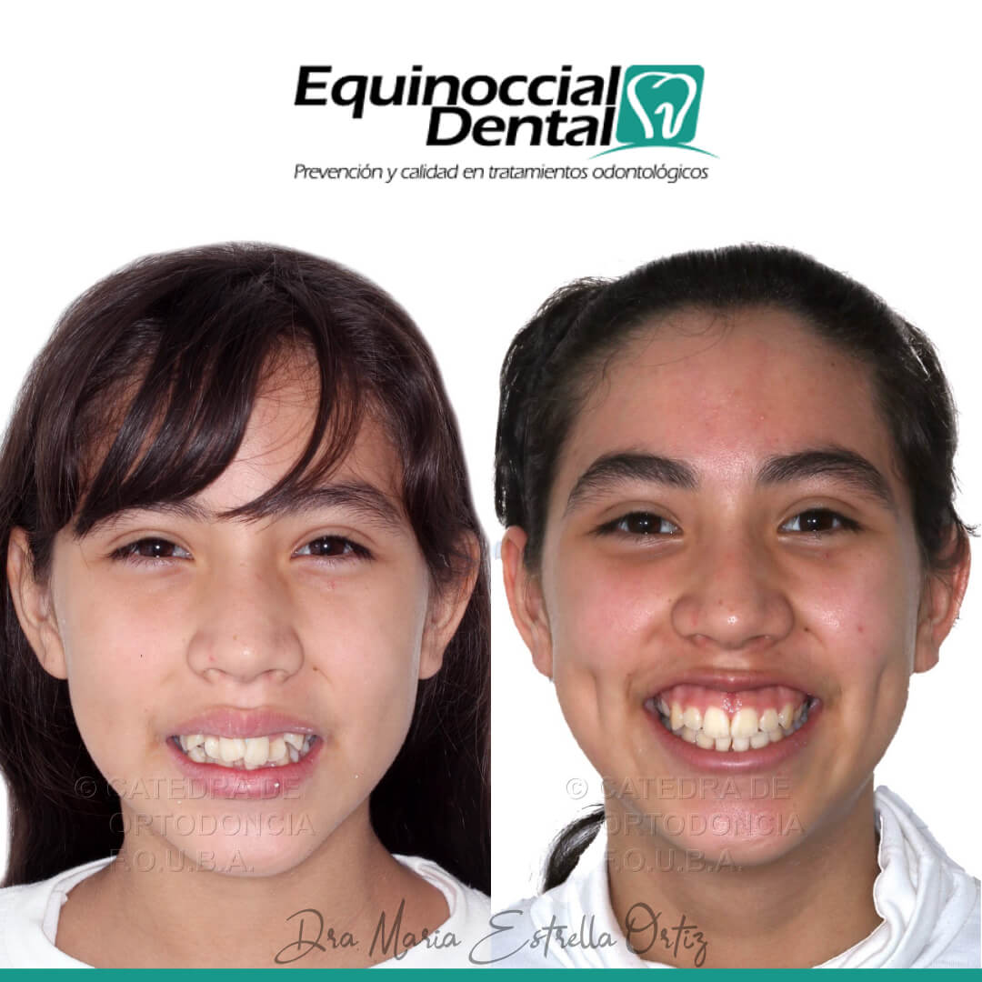 Resutaldo de Ortodoncia ✅ Logra tu mejor sonrisa en Oral Beauty 