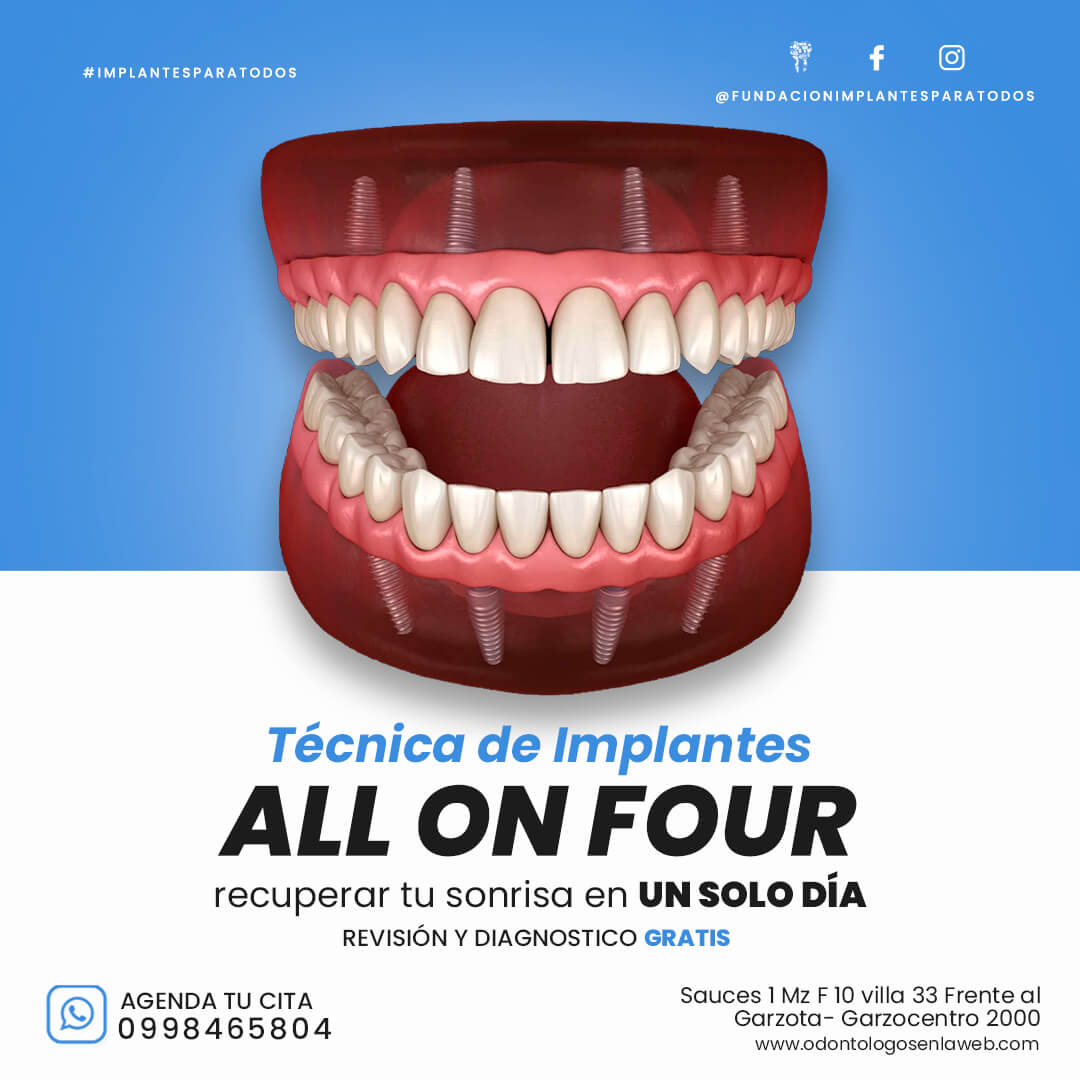 Técnica de Implantes ALL ON FOUR | recupera tu sonrisa en UN SOLO DÍA