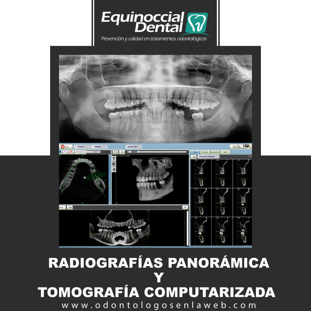 Radiografías Panorámica y Tomografía Computarizada para un certero diagnóstico y plan de tratamiento