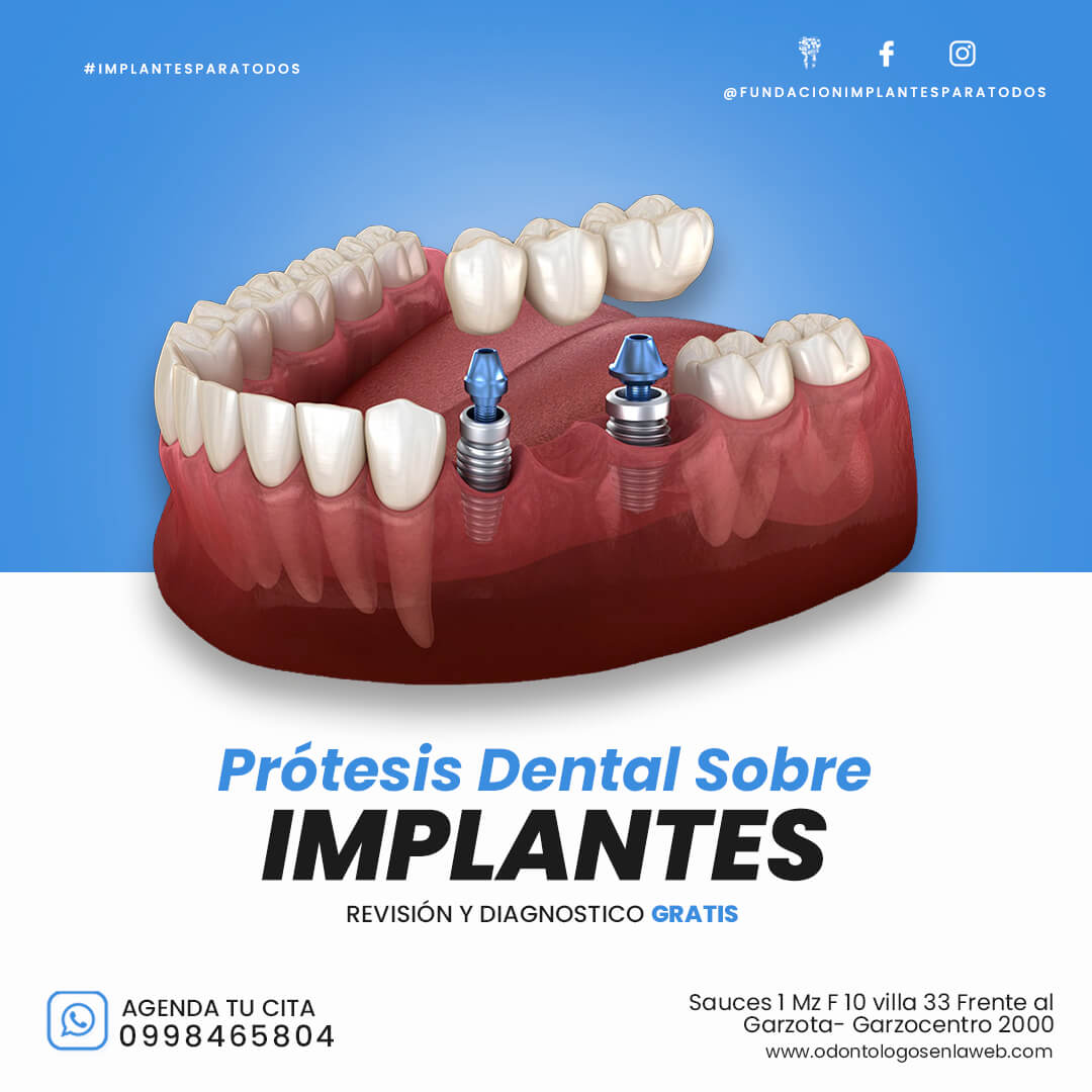 Prótesis Sobre Implantes Dentales