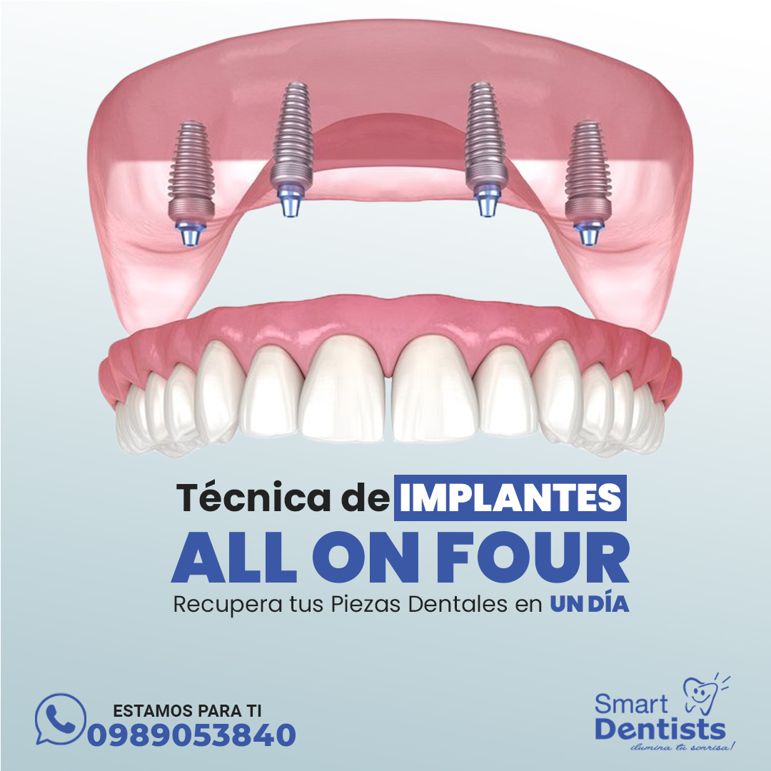 Protesis Dentales (All On Four) Recupera tu Sonrisa en Un Día