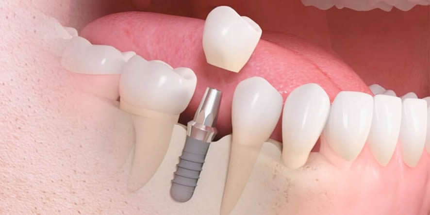 tiempo-implante-dental-3