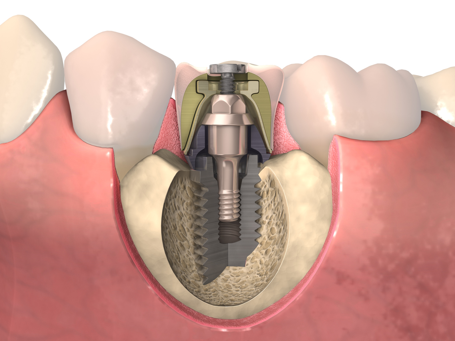 implante-dental1