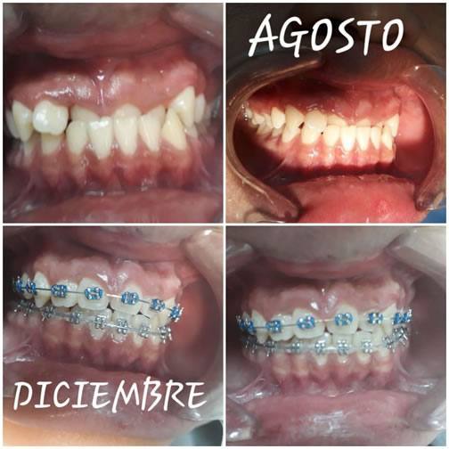 Proceso de Ortodoncia Metalica