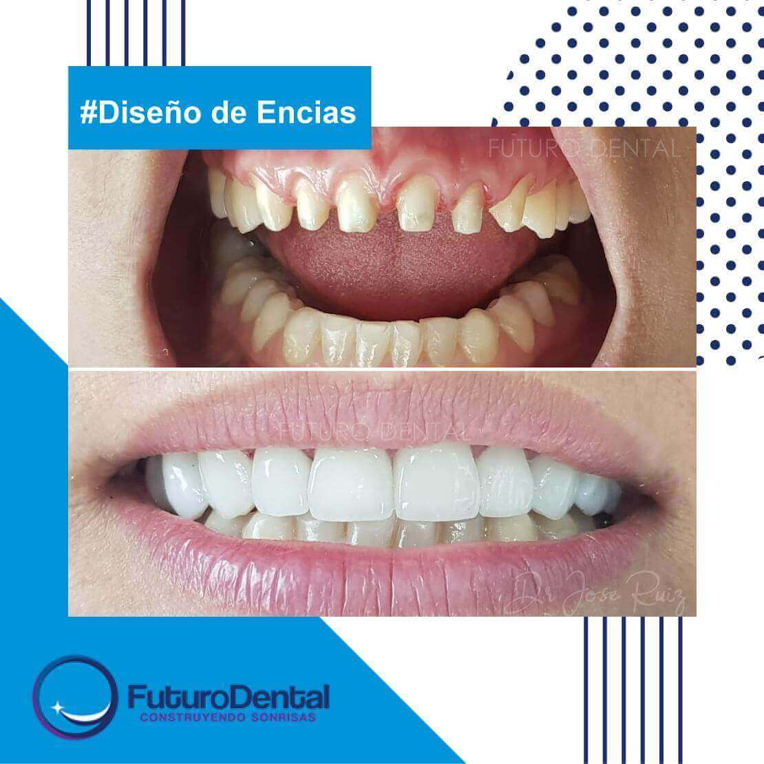 👉 Diseño de sonrisa !! Mejora tu sonrisa con carillas minimamente invasivas 😍