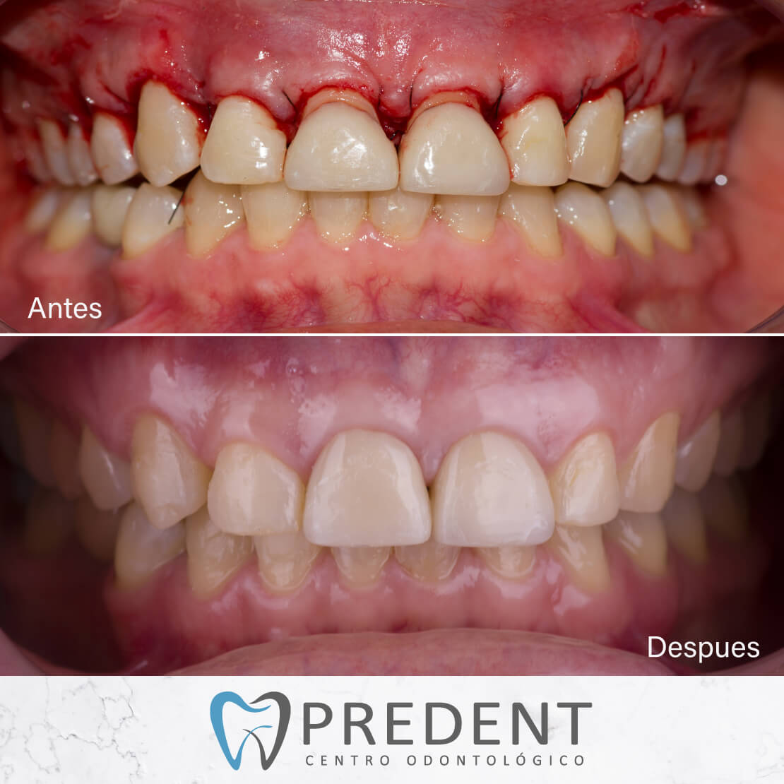 Caso de Cirugia Periodontal ✅ Culminado 