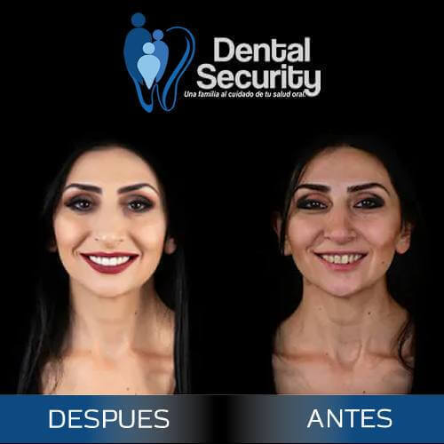 Diseño de Sonrisa