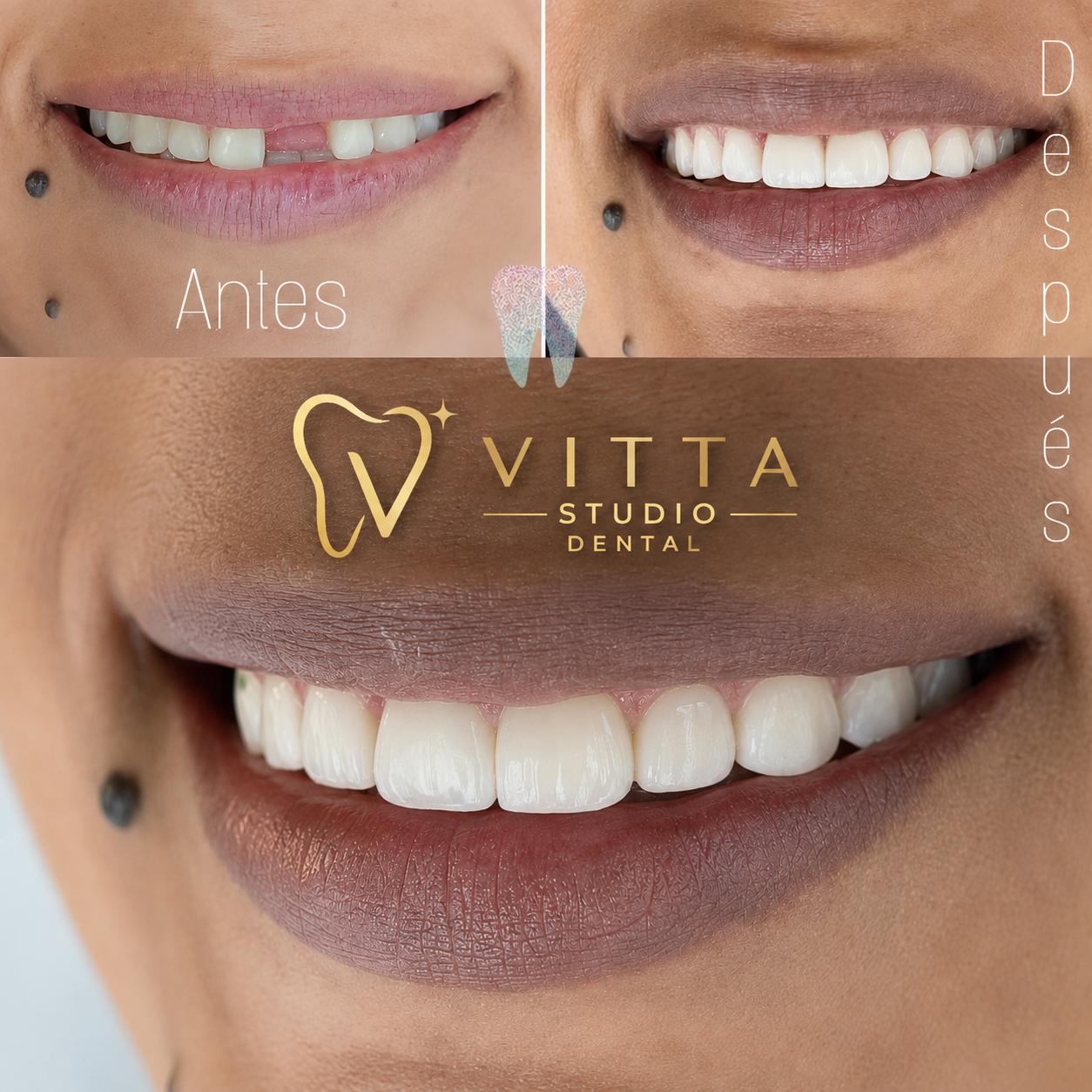 Antes y Después: Una Sonrisa Completamente Renovada
