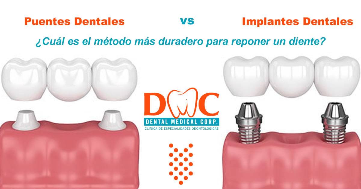 👉 Implantes dentales vs. puentes: ¿Cuál es el método más duradero para reponer un diente?
