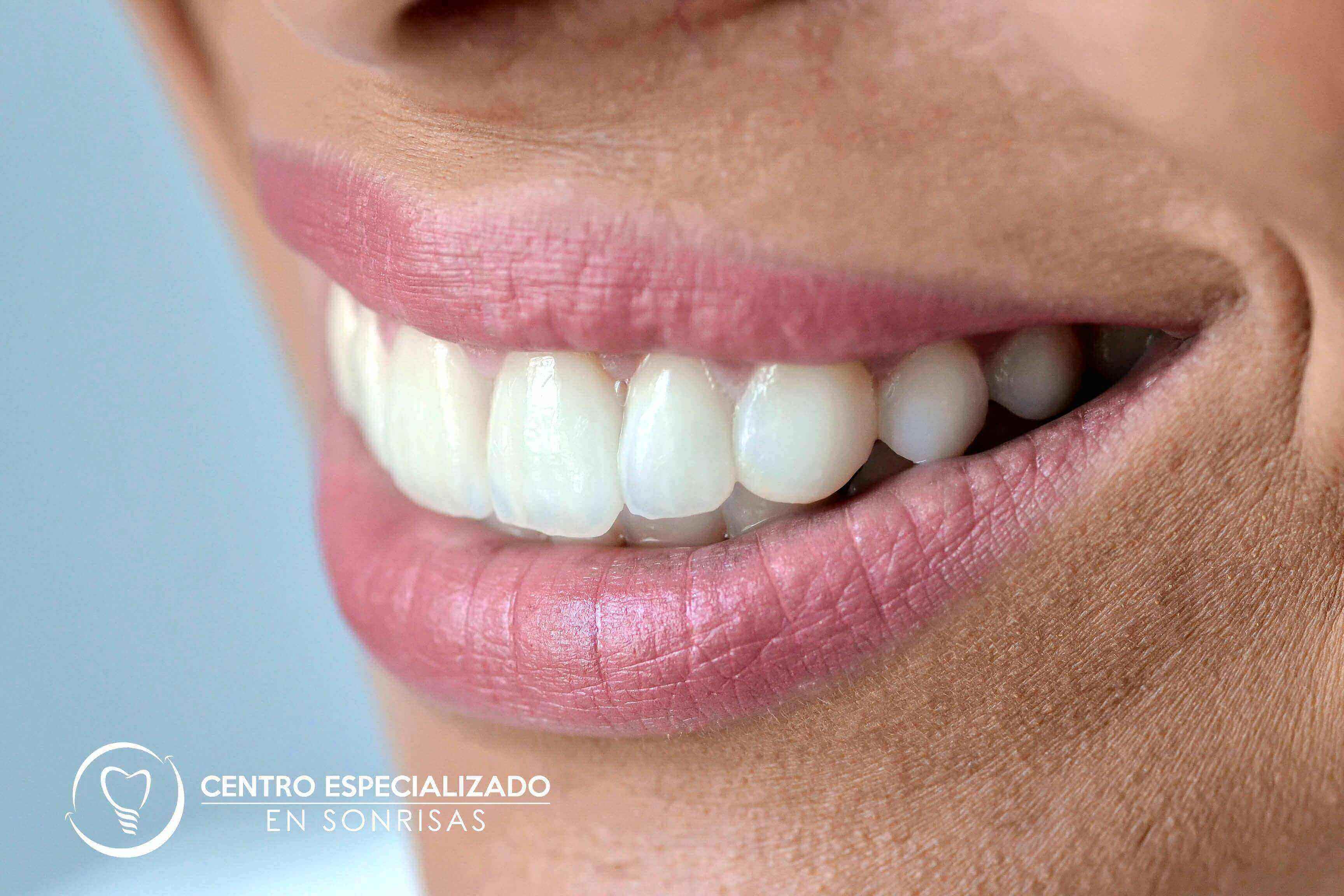 ► DISEÑO DE SONRISAS :  ¿Sabes Realmente en qué Consiste? 