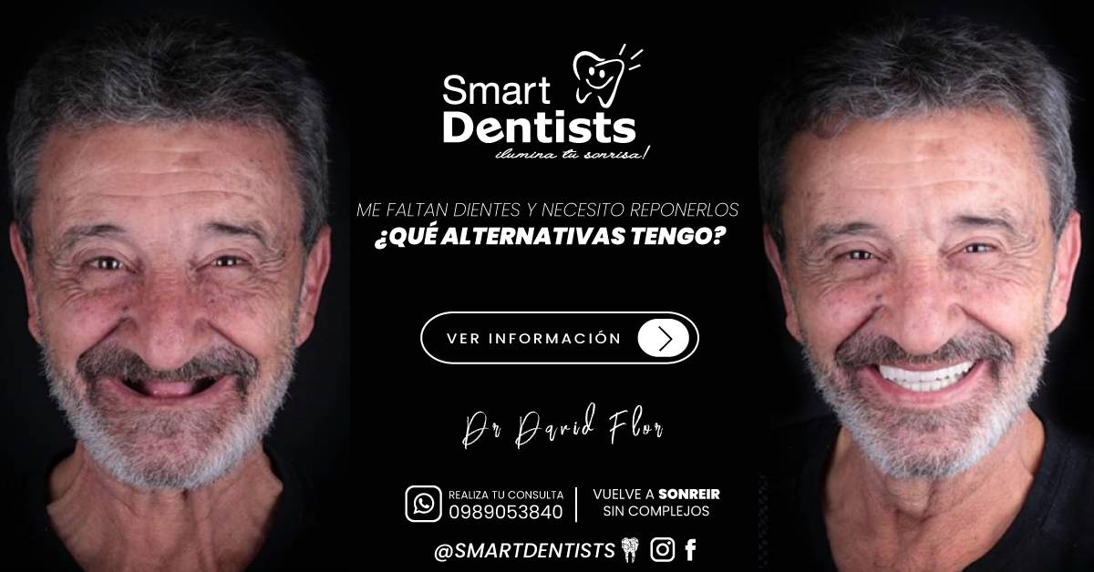 ME FALTAN DIENTES Y NECESITO REPONERLOS, ¿QUÉ ALTERNATIVAS TENGO?