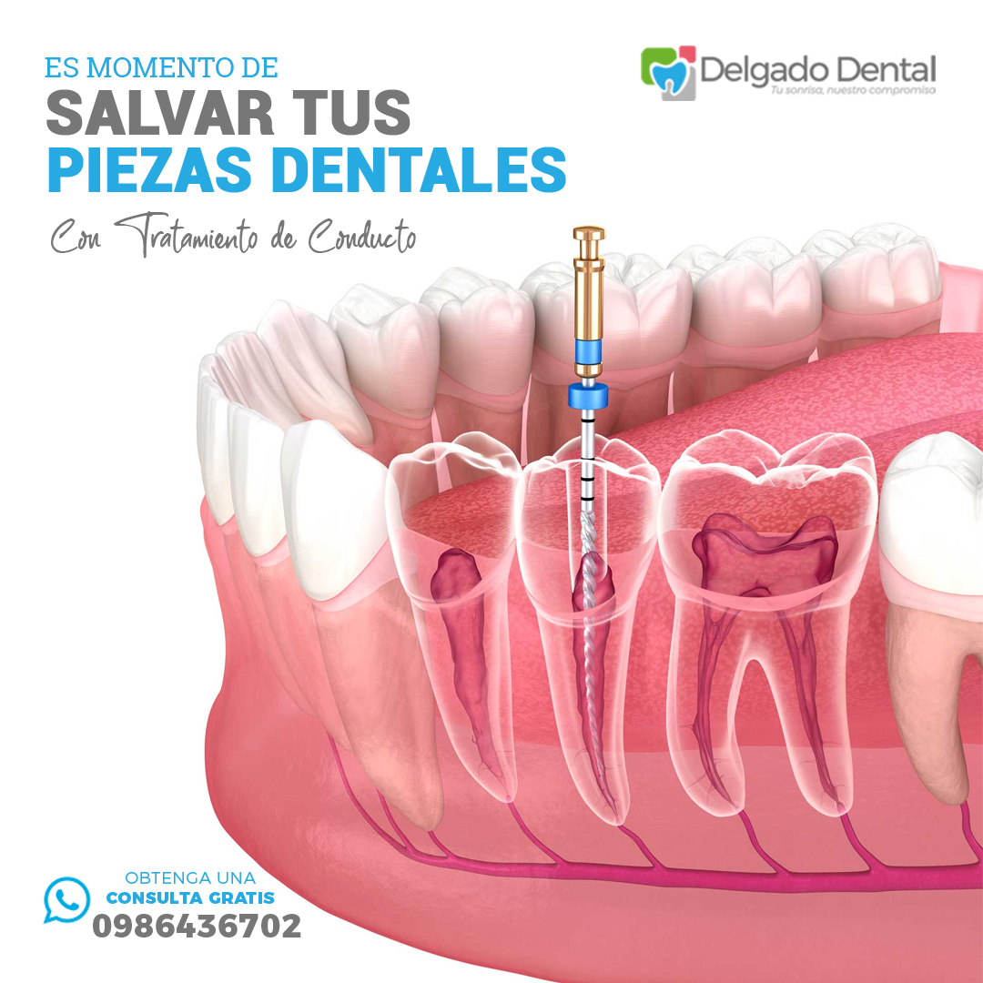 Endodoncia