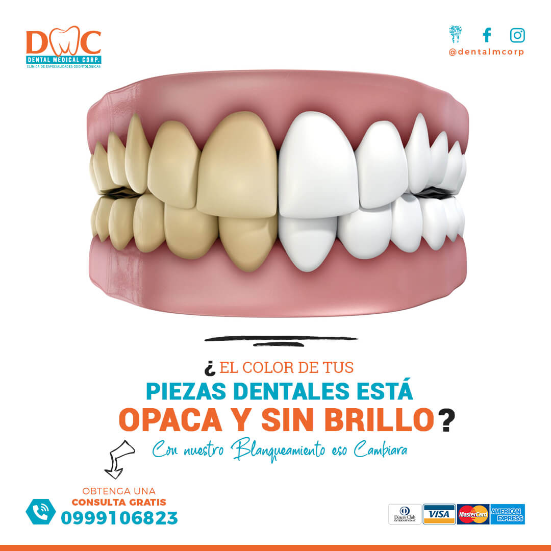 Blanqueamiento Dental