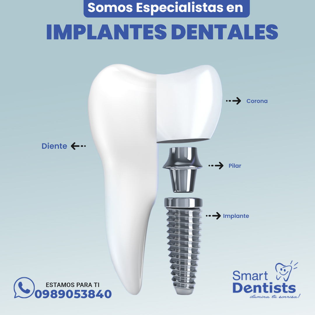 Implantes Dentales