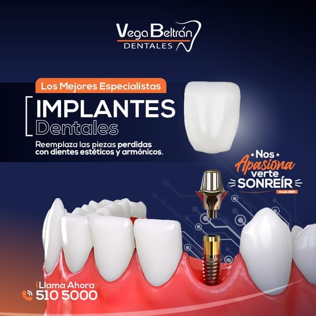 Implantes Dentales