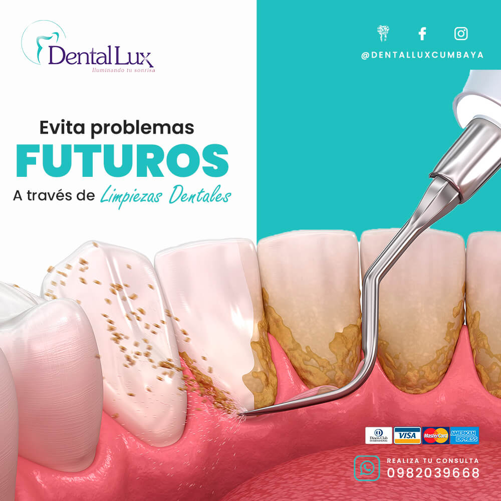 Limpieza Dental Profunda