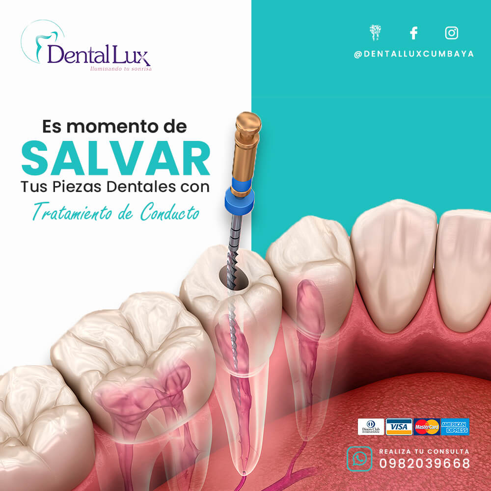 Endodoncia (Tratamiento de Conducto)