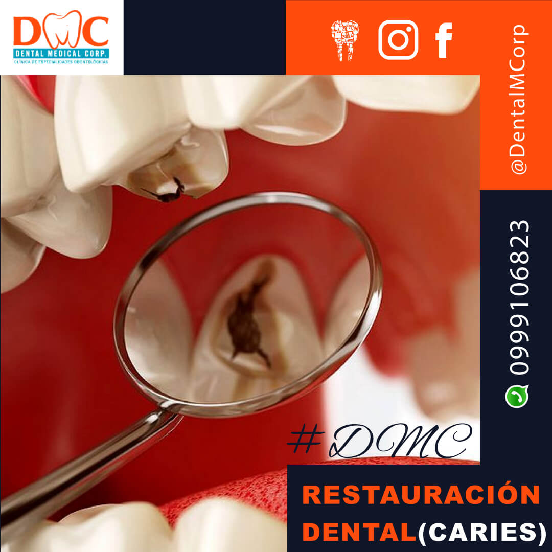 Restauración Dental (Caries)