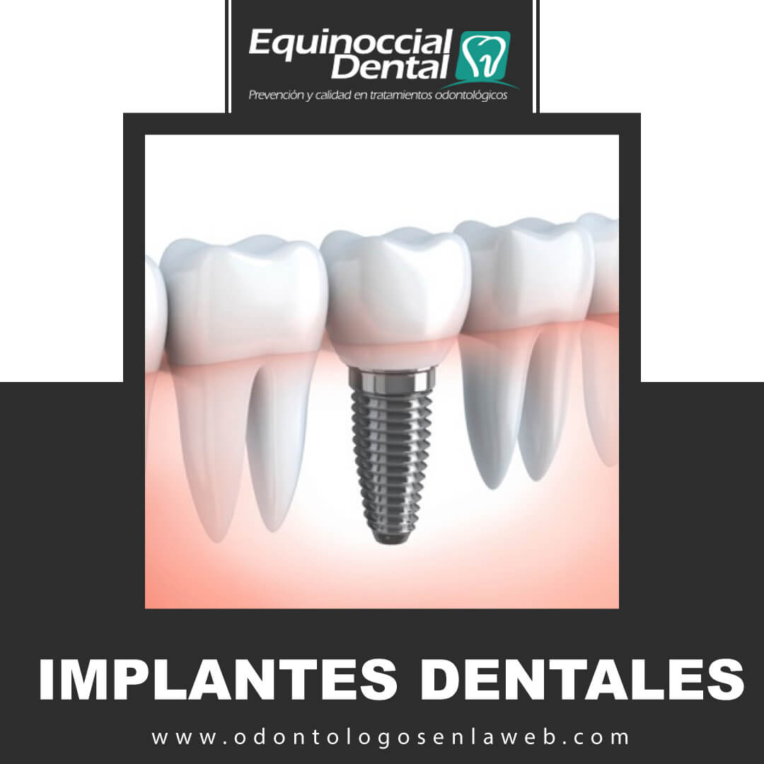 Implantes Dentales