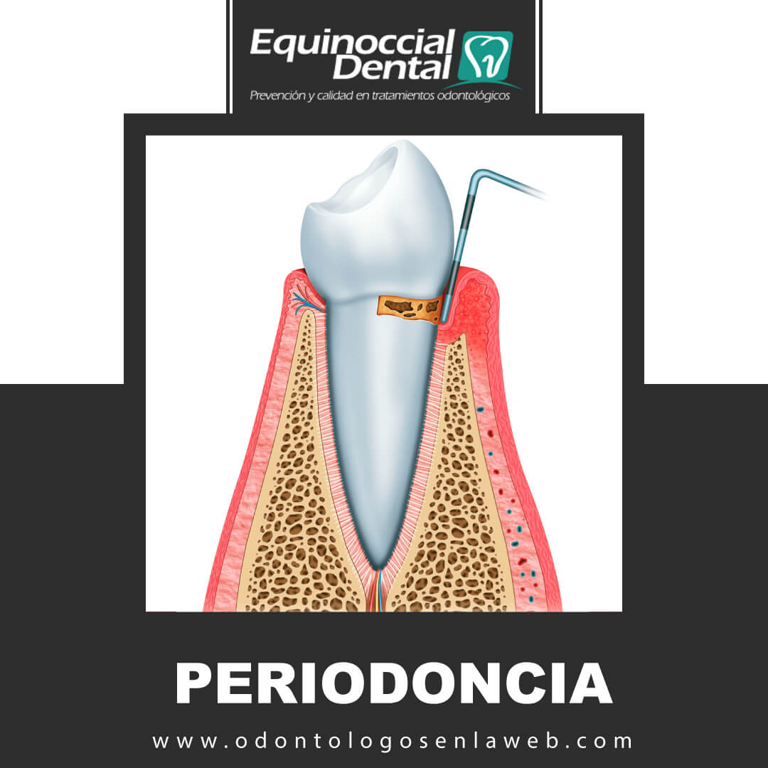 Periodoncia (enfermedad de las encías)