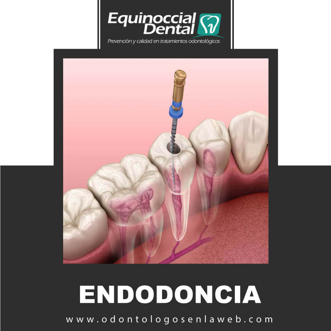 Endodoncia