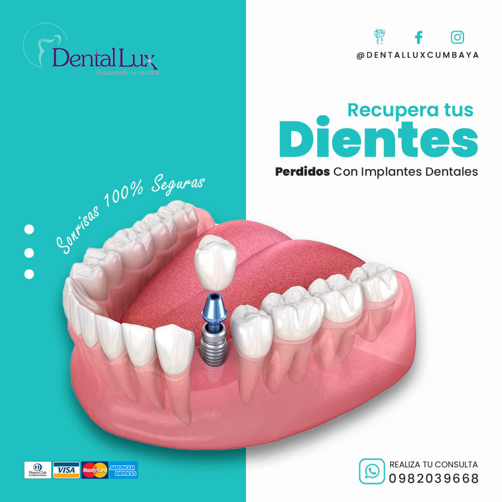 Implantes Dentales