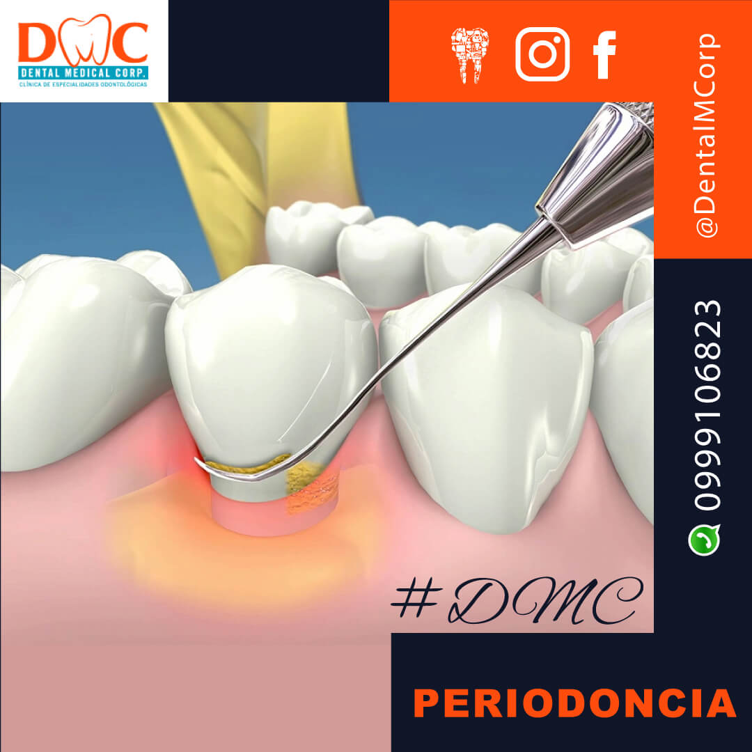 Periodoncia