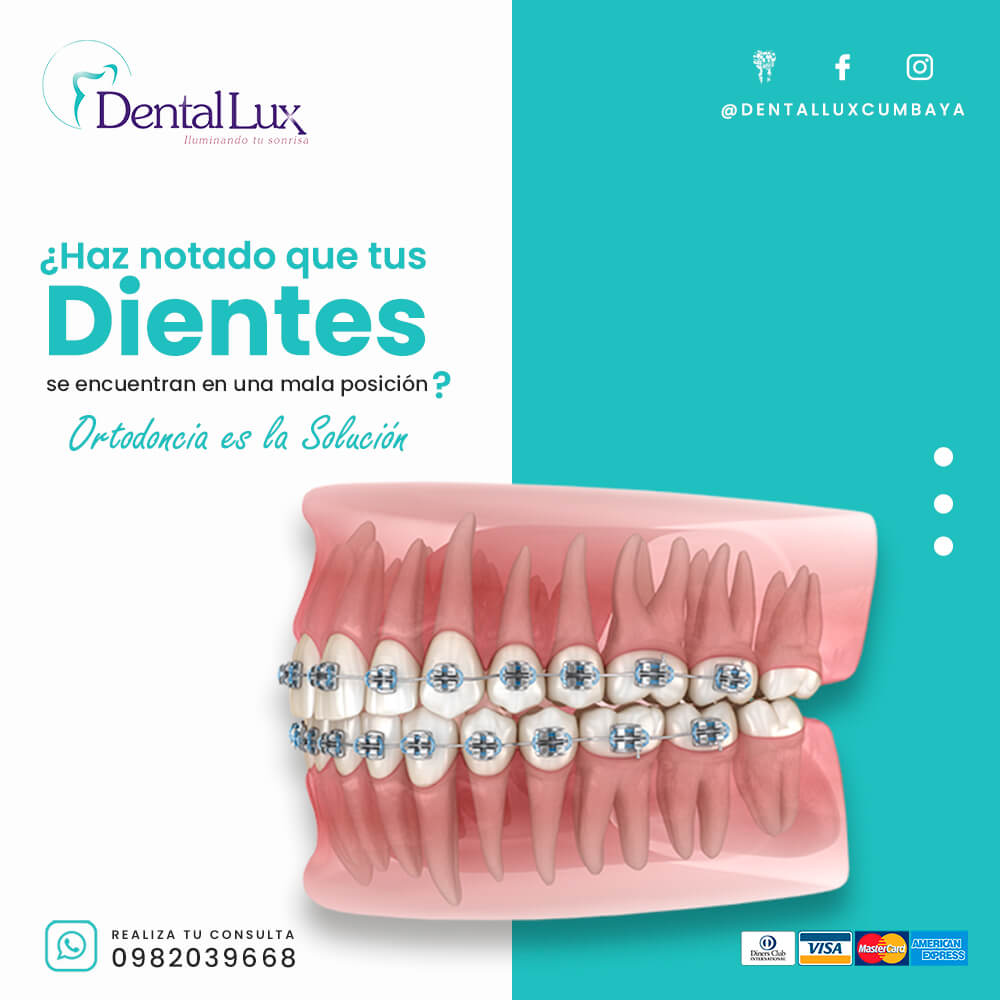 Tratamiento de Ortodoncia (Brackets)