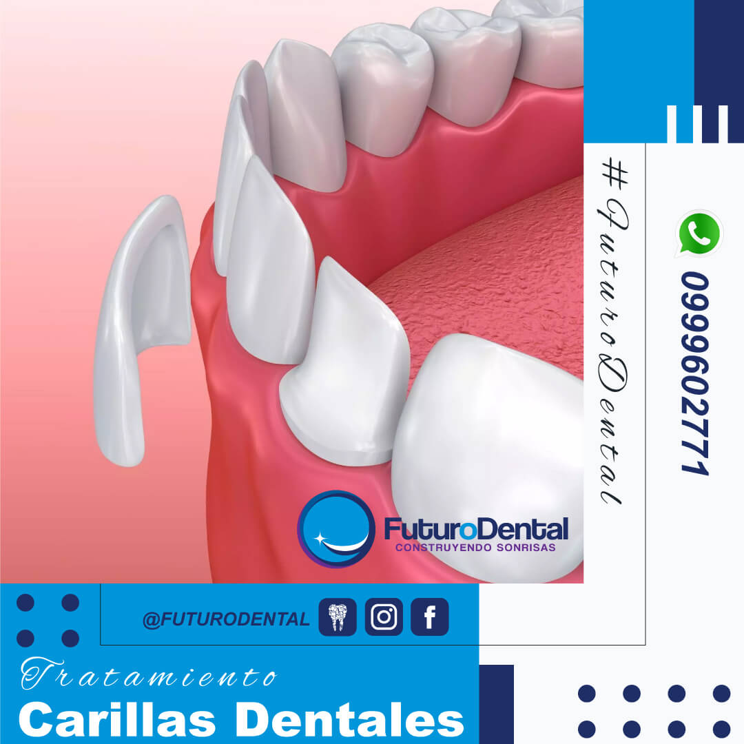 Estética Dental (Rehabilitación Oral)
