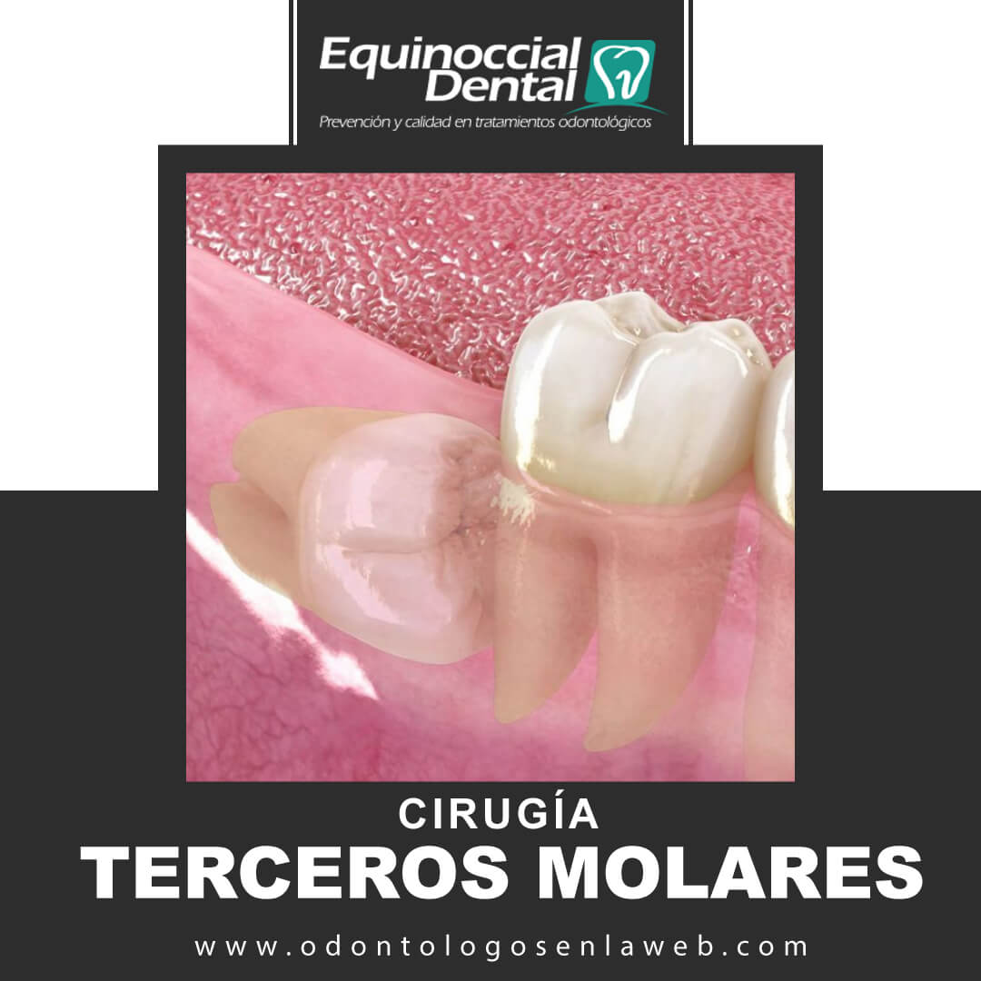 Cirugia Terceros Molares