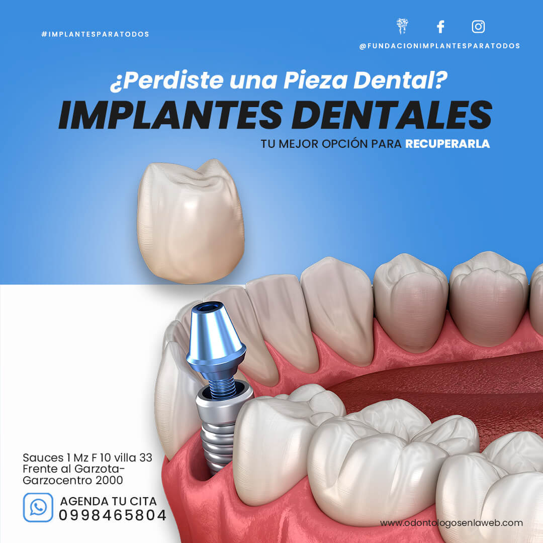 TE FALTA UN DIENTE? 😮 contamos con Implantes Dentales de Titanio GMI