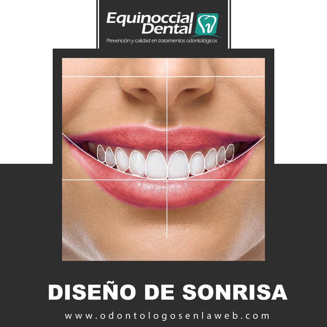 Diseño de Sonrisa 