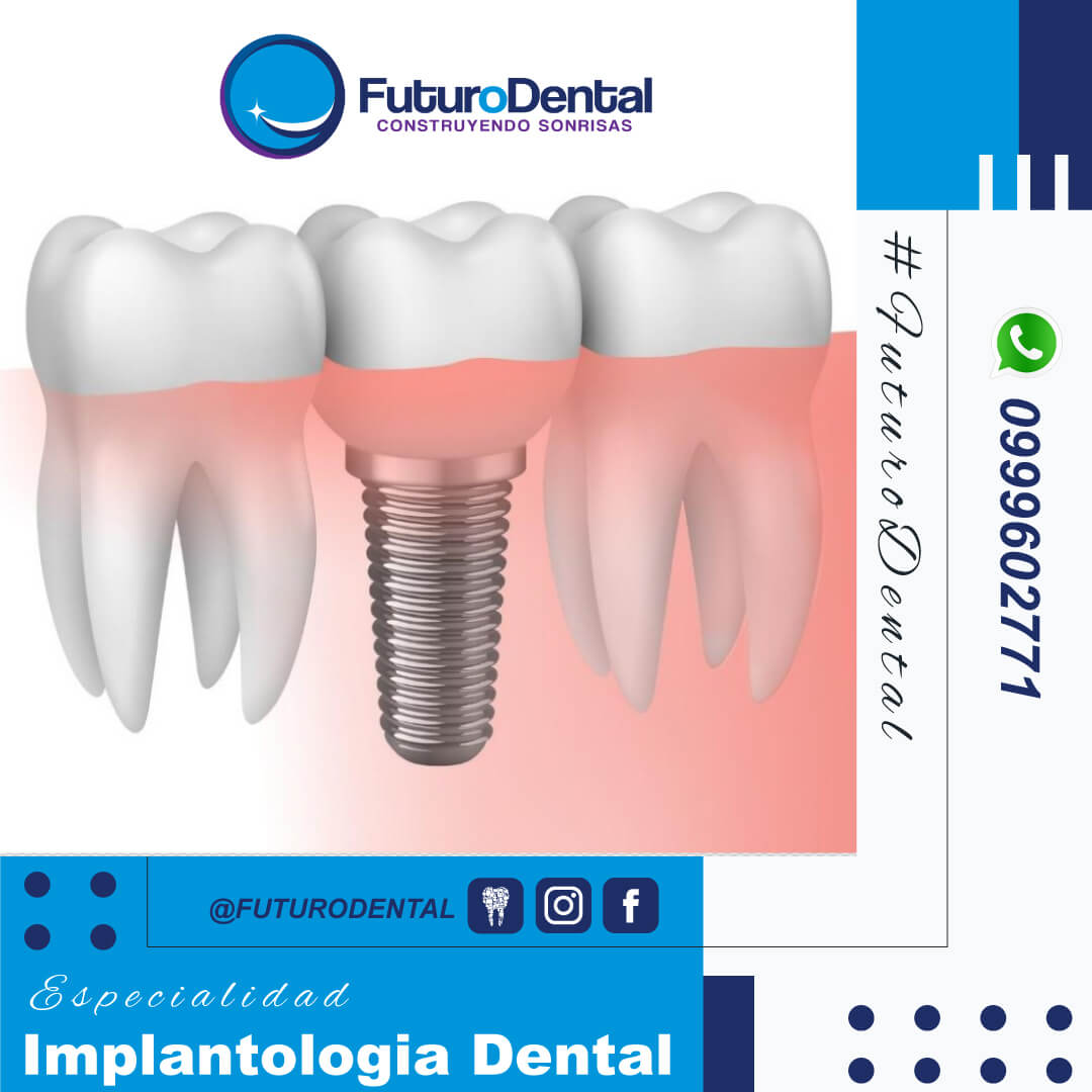 Implantes Dentales