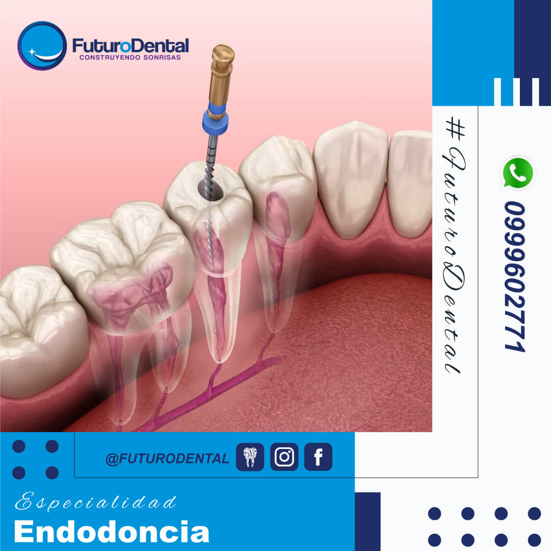 Endodoncia (Tratamiento de Conducto)