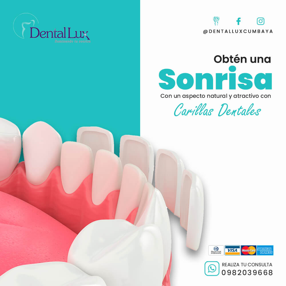 Diseño de Sonrisa (Carillas Dentales)