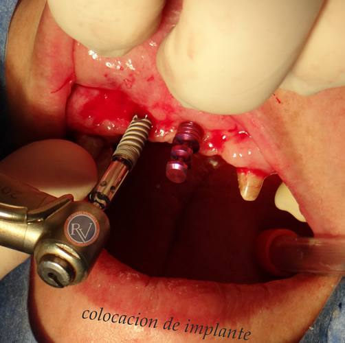 Implantologia Oral