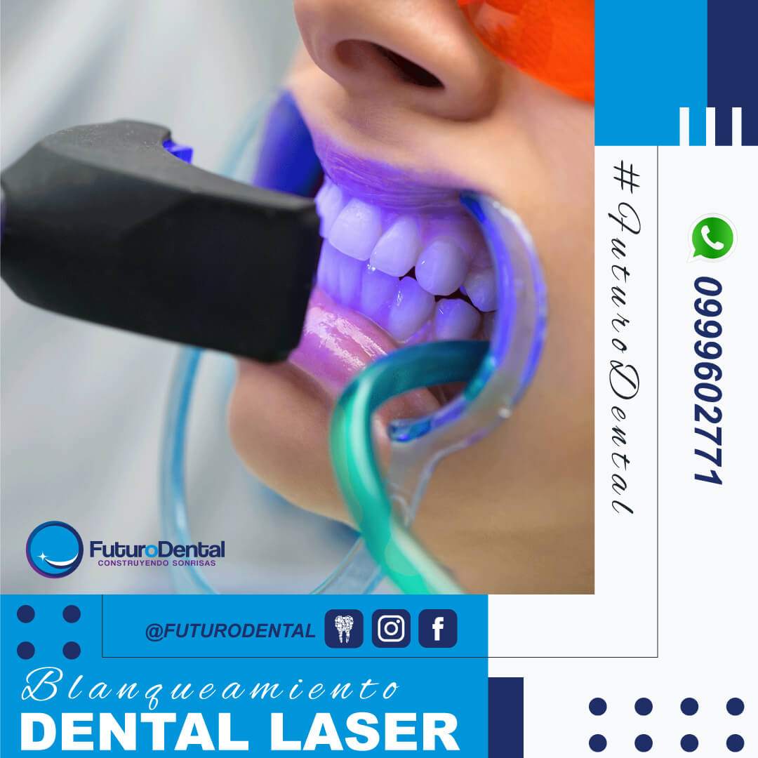 Blanqueamiento Dental Laser
