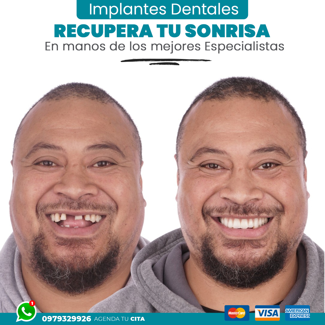 Implantes Dentales