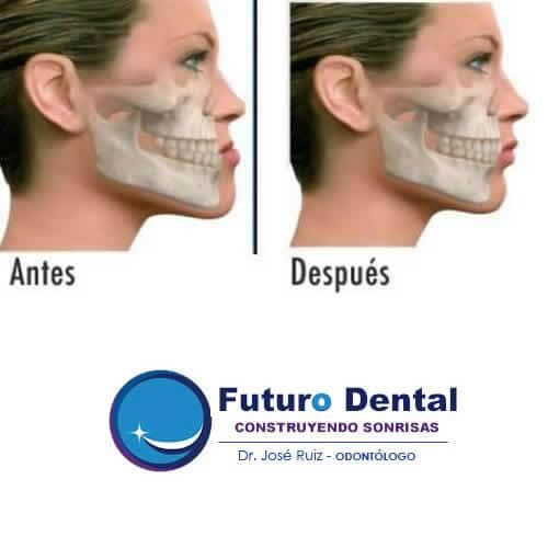 Cirugía Dento Maxilar