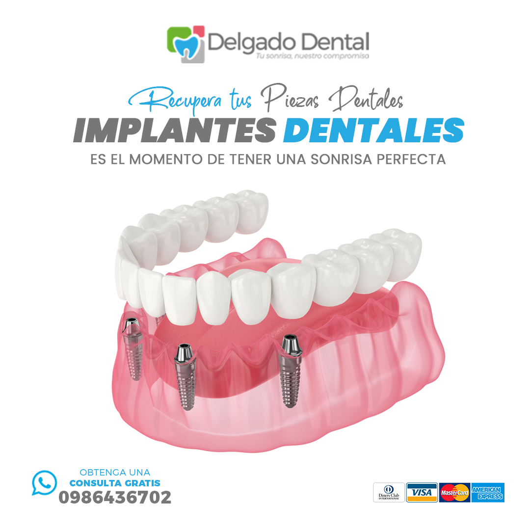 Implantes Dentales