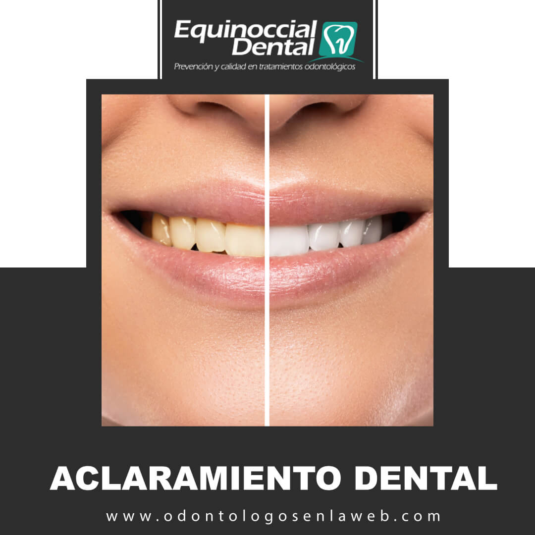 Aclaramiento Dental