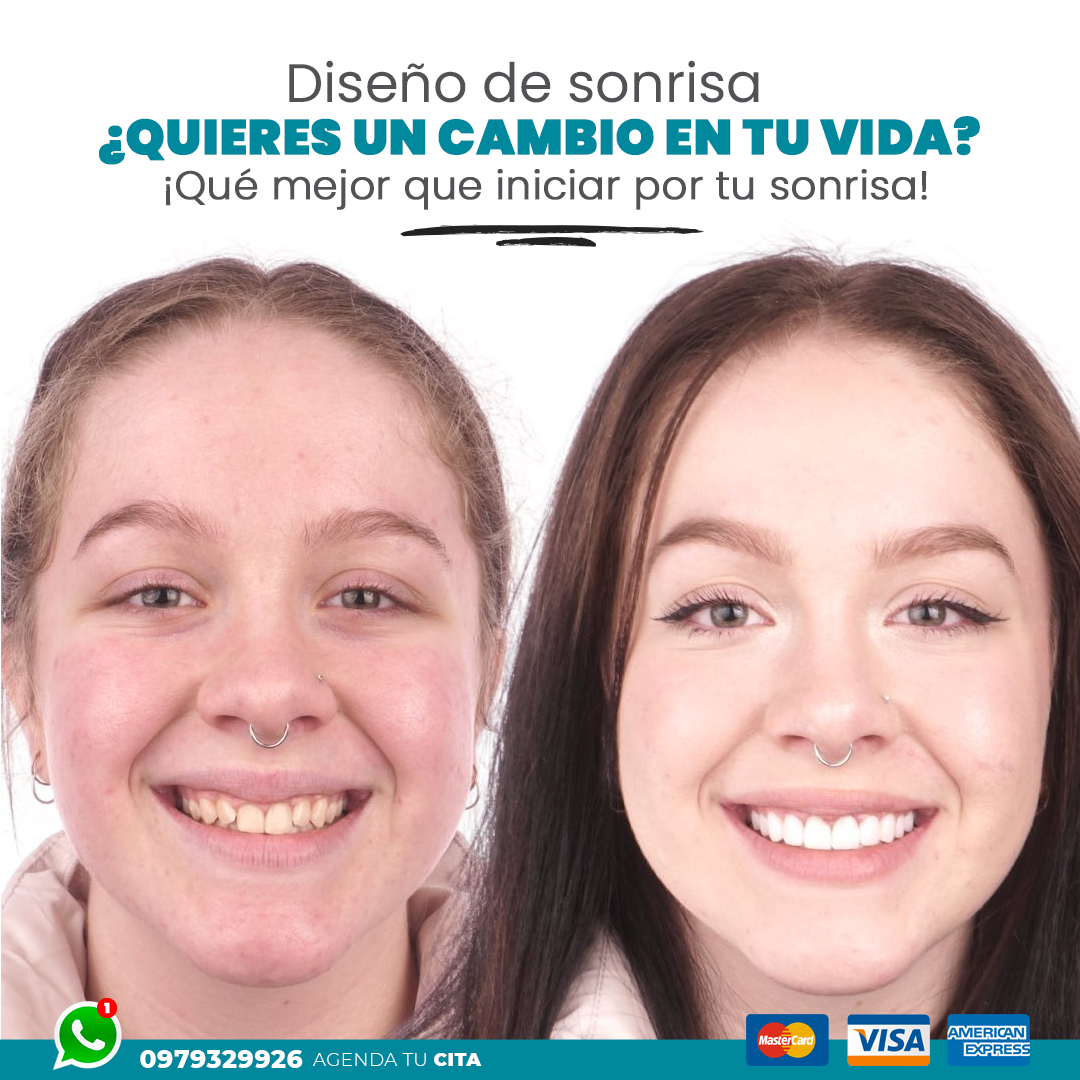 Diseño de Sonrisa