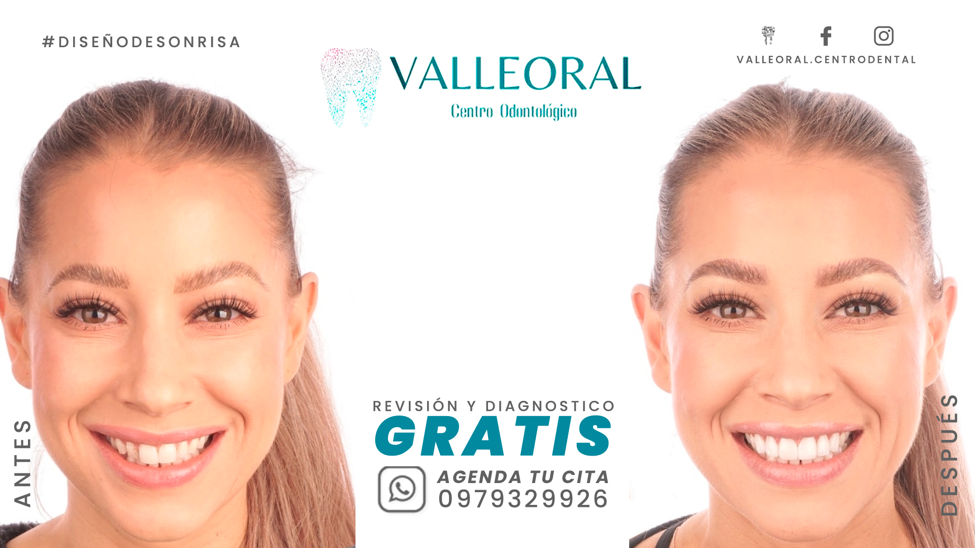 Revisión y Diagnósticos Gratuito ✨ Diseño de Sonrisa