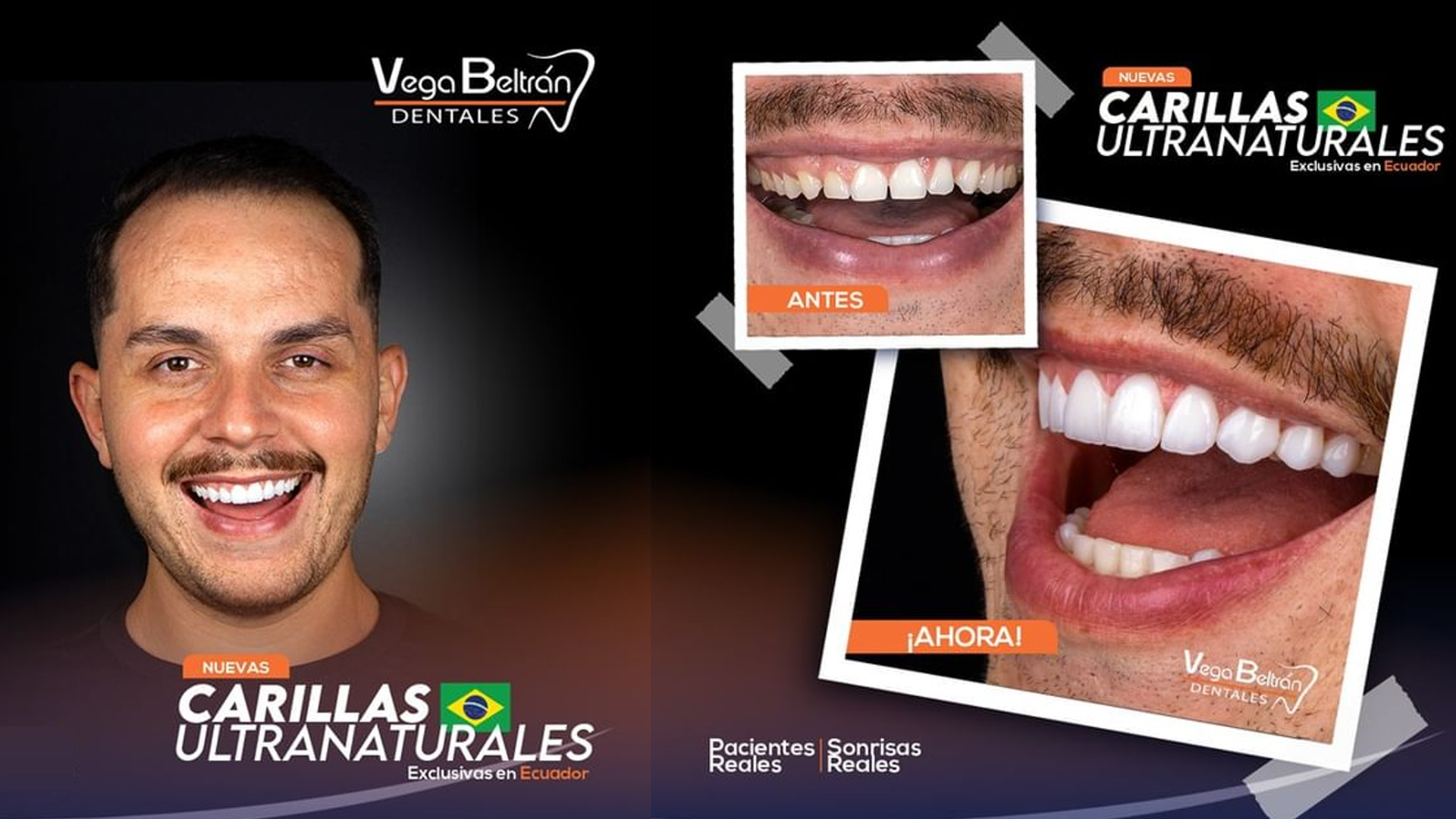 🦷✨Transforma tu sonrisa con las MEJORES CARILLAS Exclusivas en Vega Beltrán Dentales✨🦷